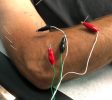Dry Needling Near Me NJ