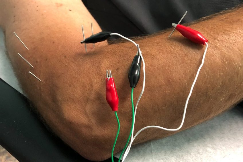 Dry Needling Near Me NJ