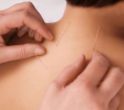 Acupuncture