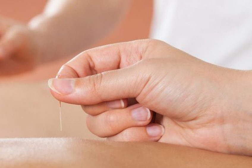 Acupuncture